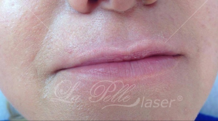 Kwas hialuronowy (Wypełnianie zmarszczek Powiększanie ust) - Beauty Complex